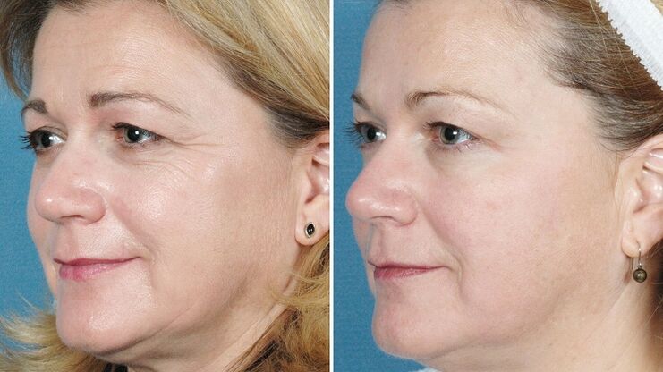 Gambar sebelum dan selepas peremajaan kulit