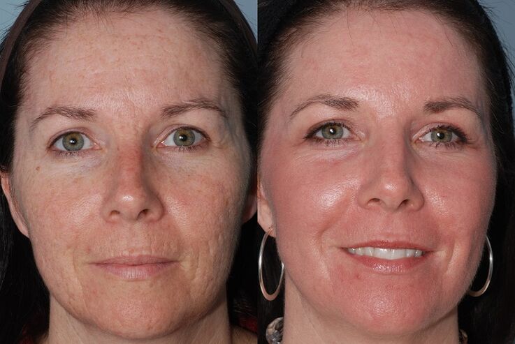 sebelum dan selepas peremajaan kulit