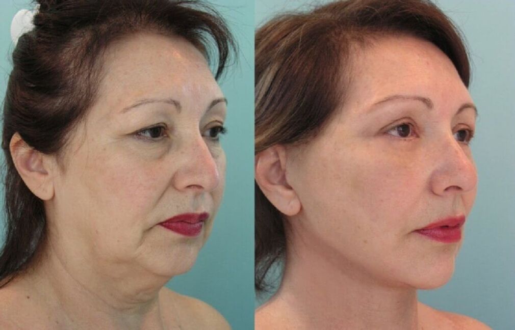 Foto sebelum dan selepas peremajaan kulit